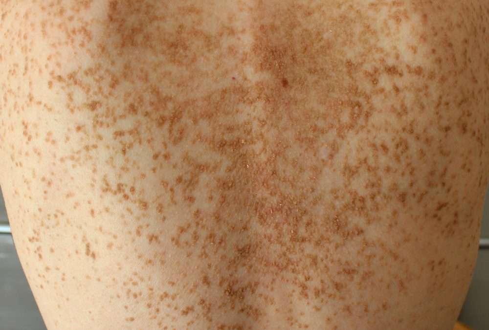 Severe dermatitis, numerous allergies, and metabolic wasting in Japanese woman with DSG1