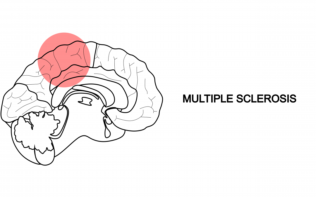 Global challenges to early detection of multiple sclerosis are severe, study finds: Neurology