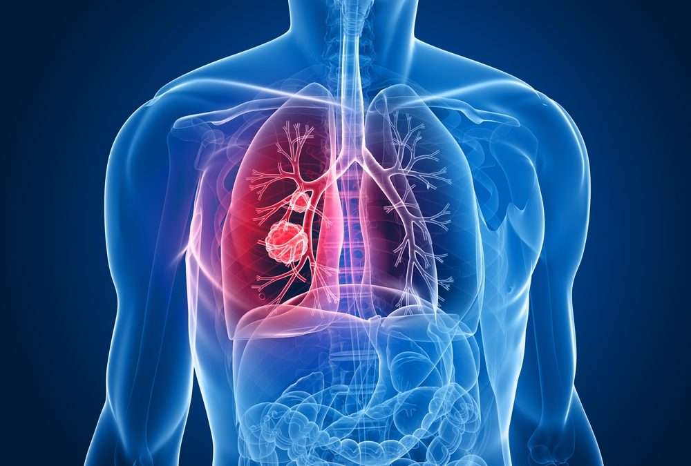 2023 European Cancer Mortality Projections with Emphasis on Lung Cancer